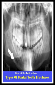 Title: Best of the Best Sellers Types Of Dental Teeth Fractures ( notch, teeth, groove, indentation, nick, notching, tooth, pricker, needle, pin, bradawl ), Author: Resounding Wind Publishing