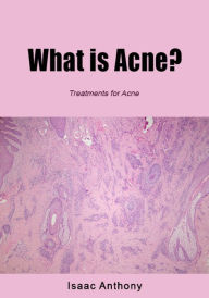 Title: What is Acne, Author: Isaac Anthony