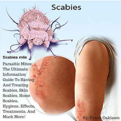 scabies skin mites hygiene parasitic treatments book information treating excerpt read