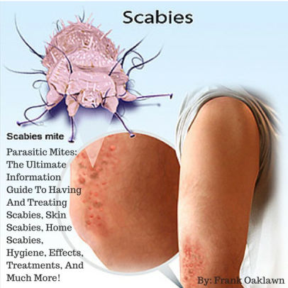 Scabies Parasitic Mites The Ultimate Information Guide To Having And Treating Scabies Skin Scabies Home Scabies Hygiene Effects Treatments And Much More By Frank Oaklawn Nook Book Ebook Barnes Noble