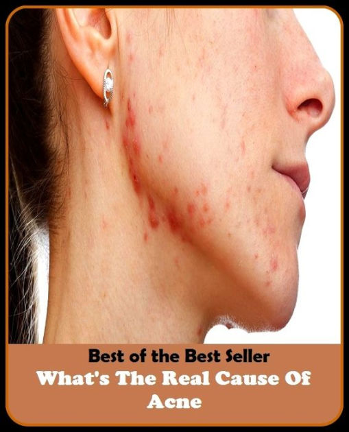 Best of the Best Sellers What S The Real Cause Of Acne (blackheads ...