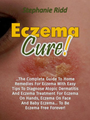 Eczema Cure The Complete Guide To Home Remedies For Eczema With Easy Tips To Diagnose