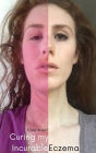 Curing my Incurable Eczema: My Topical Steroid Withdrawal (TSW) Journey