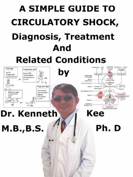 A Simple Guide to Circulatory Shock, Diagnosis, Treatment and Related Conditions