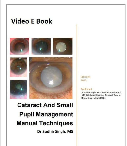 Cataract And Small Pupil Management Manual Techniques (2022, #1)