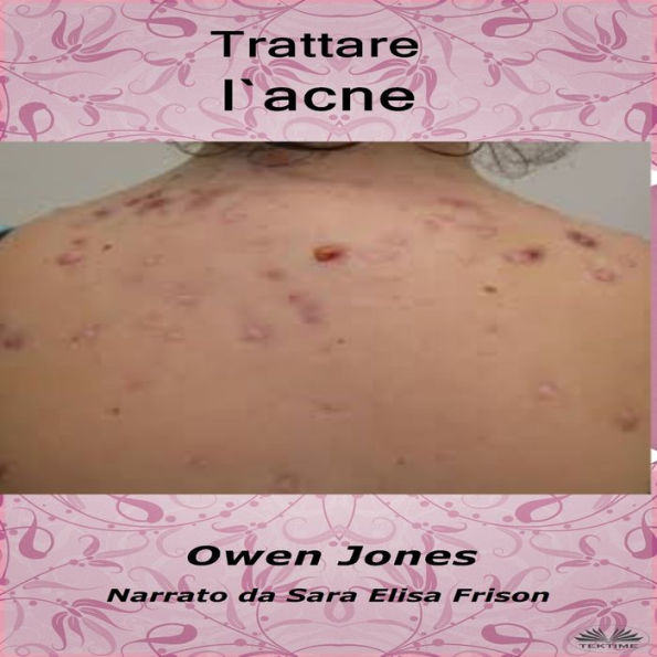 Trattare l`acne