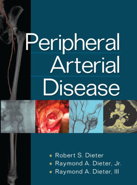 Peripheral Arterial Disease by Robert S. Dieter, Raymond A. Dieter Jr ...