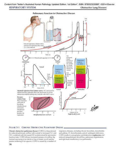 Netter's Illustrated Human Pathology Updated Edition: with Student Consult Access