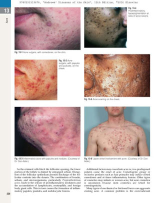 Andrews' Diseases of the Skin: Clinical Dermatology / Edition 12