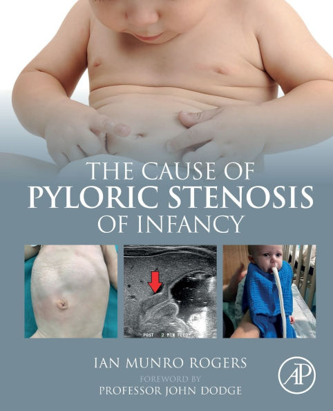 The Cause of Pyloric Stenosis Infancy