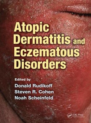 Atopic Dermatitis and Eczematous Disorders / Edition 1