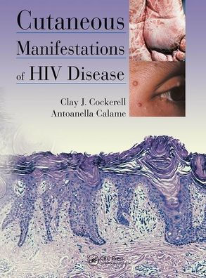 Cutaneous Manifestations of HIV Disease