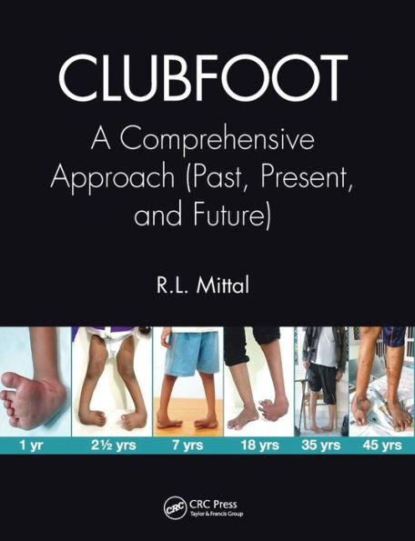 Clubfoot: A Comprehensive Approach (Past, Present