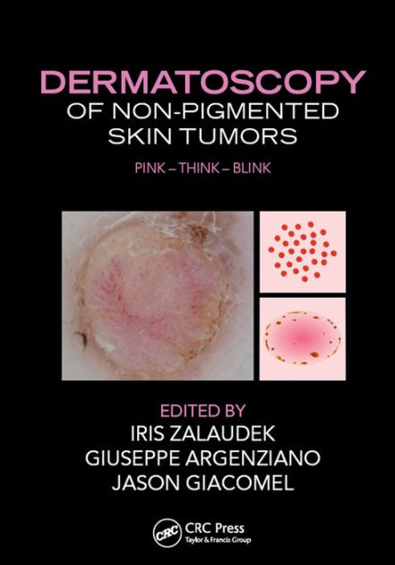 Dermatoscopy of Non-Pigmented Skin Tumors: Pink - Think - Blink by Iris ...