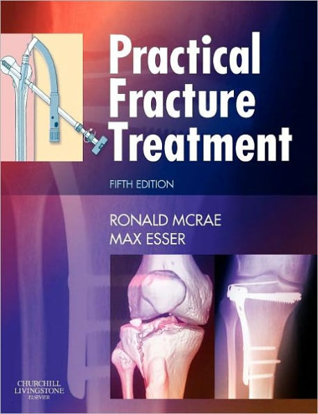 Practical Fracture Treatment / Edition 5