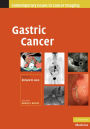 Gastric Cancer