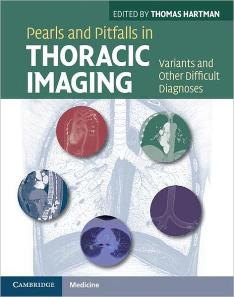 Pearls and Pitfalls in Thoracic Imaging: Variants and Other Difficult Diagnoses