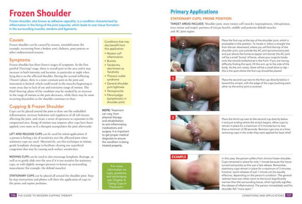 The Guide to Modern Cupping Therapy: Your Step-by-Step Source for Vacuum Therapy