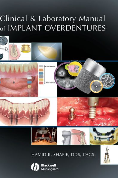 Clinical and Laboratory Manual of Implant Overdentures / Edition 1