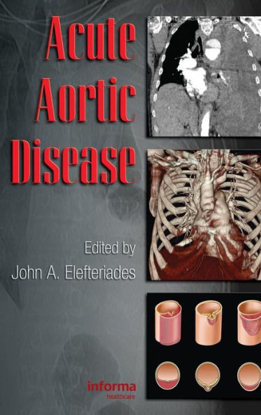Acute Aortic Disease / Edition 1