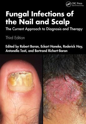 Fungal Infections of The Nail and Scalp: Current Approach to Diagnosis Therapy