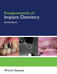 Title: Fundamentals of Implant Dentistry / Edition 1, Author: Gerard Byrne