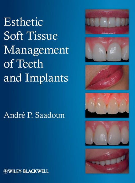 Esthetic Soft Tissue Management of Teeth and Implants / Edition 1