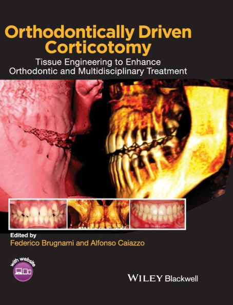 Orthodontically Driven Corticotomy: Tissue Engineering to Enhance Orthodontic and Multidisciplinary Treatment / Edition 1