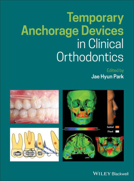 Temporary Anchorage Devices in Clinical Orthodontics