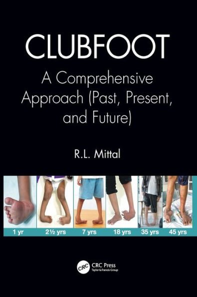 Clubfoot: A Comprehensive Approach (Past, Present, and Future) / Edition 1