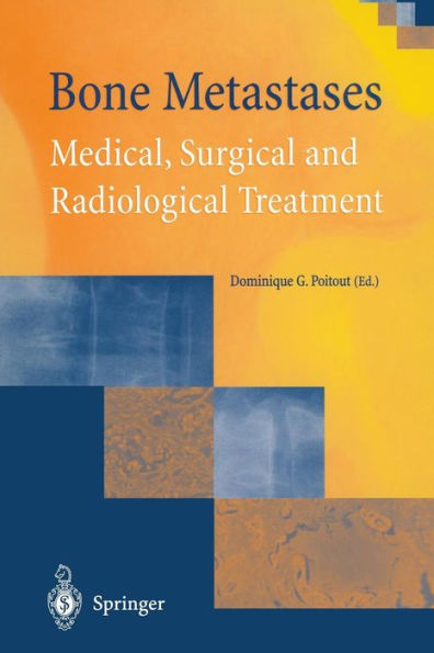 Bone Metastases: Medical, Surgical and Radiological Treatment