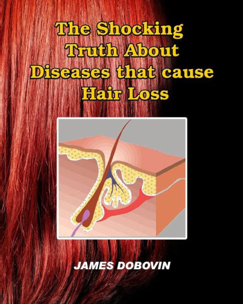 The Shocking Truth About Diseases that Cause Hair Loss: Secrets You Need to Know About Losing Hair So You Can Stop From Going Bald