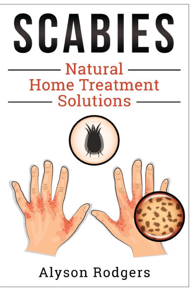 Scabies Natural Home Treatment Solution