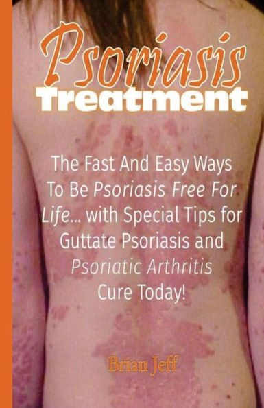 Psoriasis Treatment: The Fast and Easy Ways to Be Psoriasis Free for Life... with Special Tips for Guttate Psoriasis and Psoriatic Arthritis Cure Today!