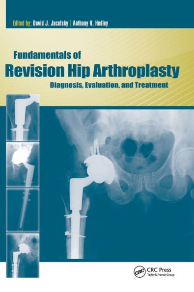 Fundamentals of Revision Hip Arthroplasty: Diagnosis, Evaluation, and Treatment / Edition 1