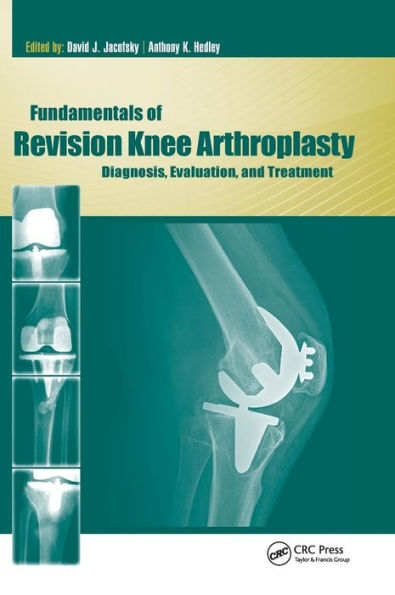 Fundamentals of Revision Knee Arthroplasty: Diagnosis, Evaluation, and Treatment / Edition 1