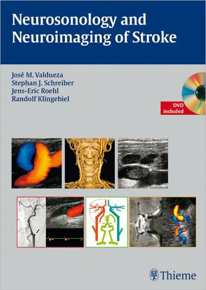 Neurosonology and Neuroimaging of Stroke