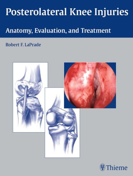 Posterolateral Knee Injuries: Anatomy, Evaluation, and Treatment