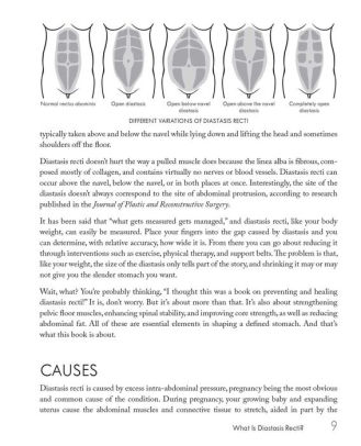 Mom's Guide To Diastasis Recti: A Program For Preventing And Healing 