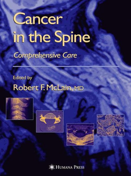 Cancer in the Spine: Comprehensive Care