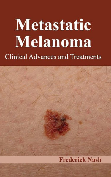 Metastatic Melanoma: Clinical Advances and Treatments