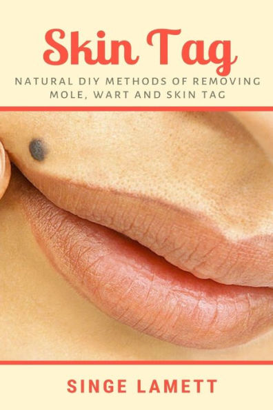 Skin Tag: Natural DIY Methods of removing Mole, Wart and Tag