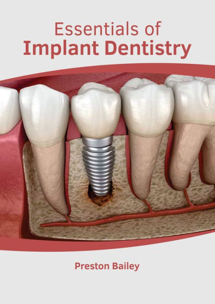 Essentials of Implant Dentistry