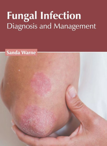 Fungal Infection: Diagnosis and Management