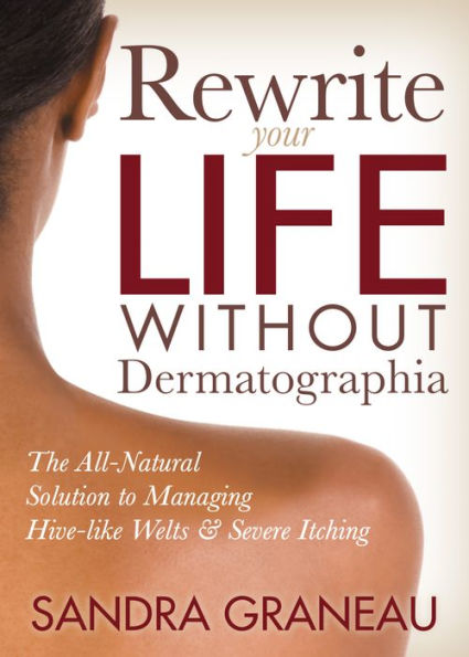 Rewrite Your Life Without Dermatographia: The All-Natural Solution to Managing Hive-like Welts and Severe Itching