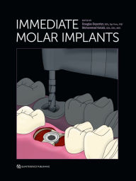 Title: Immediate Molar Implants, Author: Douglas Deporter