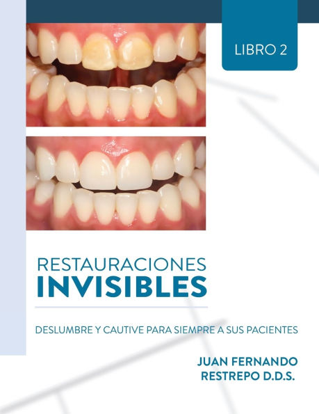 Restauraciones Invisibles: Deslumbre Y Cautive Para Siempre A Sus Pacientes