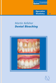 Title: Dental Bleaching, Author: Martin Kelleher