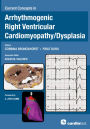 Current Concepts in Arrhythmogenic Right Ventricular Cardiomyopathy/Dysplasia