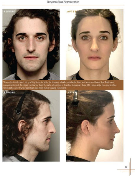 Facial Feminization Surgery: The Journey to Gender Affirmation - Second Edition / Edition 2